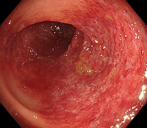 【症例5】　虚血性大腸炎