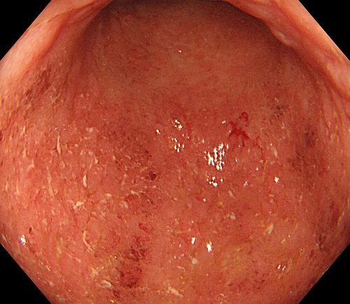 【症例9】　潰瘍性大腸炎