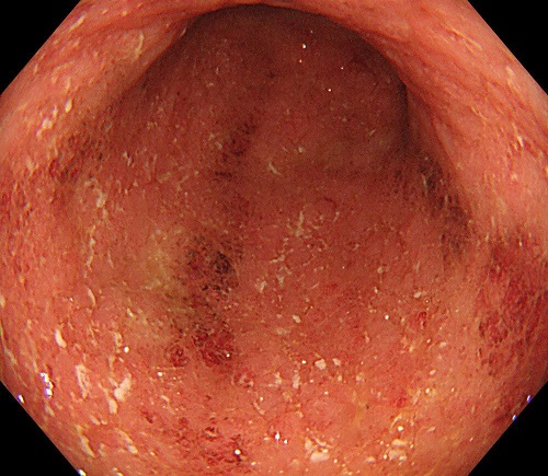 【症例9】　潰瘍性大腸炎