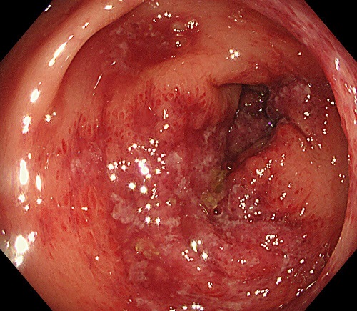 【症例5】　虚血性大腸炎