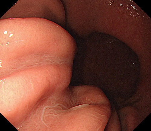 【症例4】　胃アニサキス症