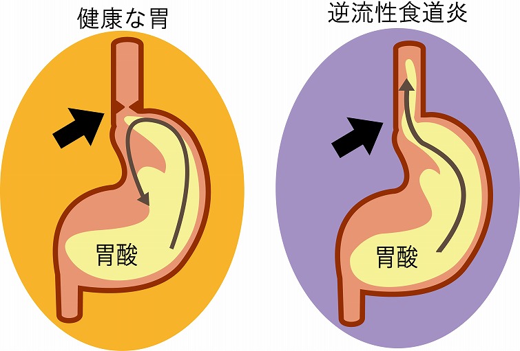 逆流 性 食道 炎 食事