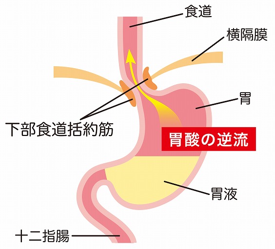 逆流性食道炎になる原因